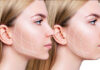 تزریق فیلر filler